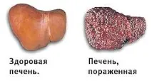 Болить печінку, що робити печінки