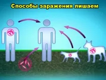Чим лікувати лишай у дитини повинен визначати лікар повинен