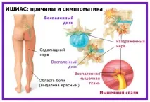 Що таке ішіас симптоми, причини, лікування в домашніх умовах ішіас