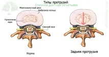 Дорсальна (задня) протрузія – діагностика, лікування » Клініка Лікаря Ігнатьєва клініка