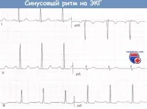 синусовому