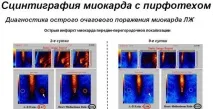 Інфаркт міокарда міокарда