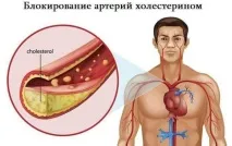 Інфаркт міокарда нападу