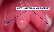 Як лікувати ангіну Болить у горлі - чим лікувати мигдаликів