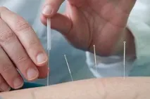 акупунктура