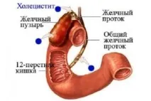 Как да се лекува холецистит на жлъчния мехур с лекарства