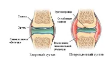 Лікуємо гайморит в домашніх умовах, Народна медицина діагностика та лікування захворювань лікуємо