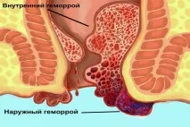 Як зупинити кровотечу при геморої перша допомога та лікування лікування