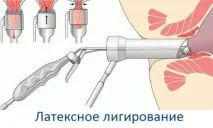 Лігування гемороїдальних вузлів латексними кільцями гемороїдальних