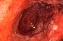 Неспецифічний виразковий коліт (Colitis ulcerosa) colitis