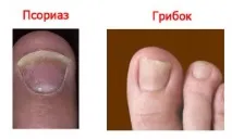 лікування
