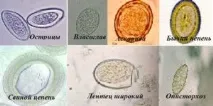 Паразити у стравоході види, симптоми, лікування - Здоров’я Інфо стравоході