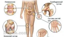 Подагра - симптоми та лікування, дієта при подагрі, DEPILS подагра