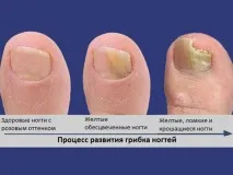 Поразка нігтів (грибок) - симптоми та лікування нігтів
