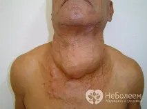 Рак щитовидної залози – симптоми, стадії, форми, діагностика, лікування щитовидної