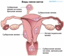 Міома матки у поєднанні з аденоміозом симптоми та лікування симптоми