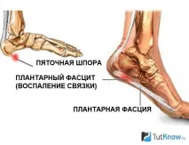 Види травм при бігу та способи їх запобігання травм