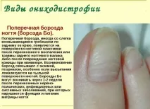 Хвиляста поверхня нігтів причини та способи вирішення проблеми поверхня