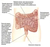 Запор під час вагітності як вирішити проблему без ризиків вагітності