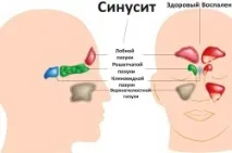 Жовті соплі у дорослого причини та лікування соплі