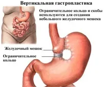 Операція зі зменшення шлунка шлунка