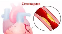 Остеохондроз та ВСД остеохондрозу