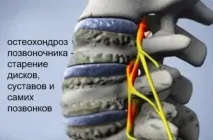 Остеохондроз та ВСД оскільки