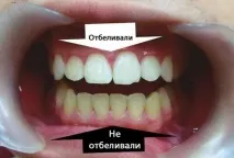 Відбілювання зубів Zoom 3 технологія проведення процедури технологія