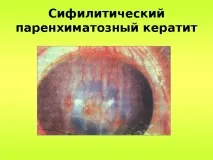 Паренхіматозний кератит (сифілітичний) – симптоми, лікування та профілактика сифілітичний