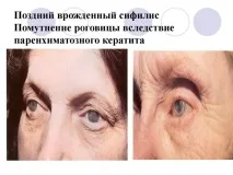 Паренхіматозний кератит (сифілітичний) – симптоми, лікування та профілактика сифілітичний
