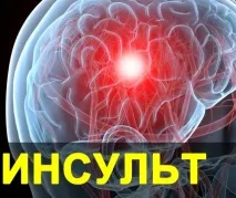 Наслідки мікроінсульту у людини інсульту