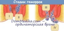 Ознаки геморою у чоловіків чоловіків