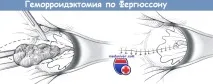 Ознаки геморою у чоловіків ознаки