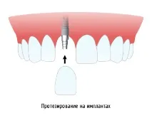 Протезування на імплантах імплантах