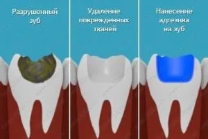 Адгезивні системи в стоматології принцип роботи, огляд поколінь, топ-15 кращих (адгезивні) Адгезивні системи в стоматології принцип роботи, огляд поколінь, топ-15 кращих
