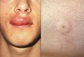 Алергія на укуси комах її симптоми і методи лікування (комах) Алергія на укуси комах її симптоми і методи лікування
