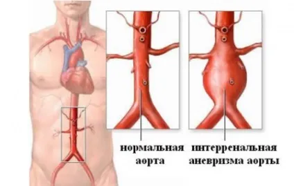 Аневризма аорти черевної порожнини симптоми і лікування