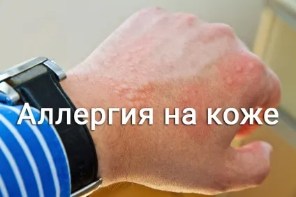Алергія на шкірі що це таке і як це лікувати (таке) Алергія на шкірі що це таке і як це лікувати