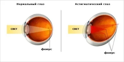 Астигматизм причини, ознаки та симптоми, лікування (лікування) Астигматизм причини, ознаки та симптоми, лікування