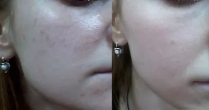 Атравматична чистка обличчя безпечна, але ефективна (атравматична) Атравматична чистка обличчя безпечна, але ефективна