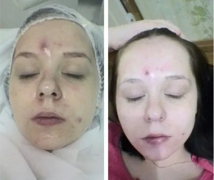 Атравматична чистка обличчя безпечна, але ефективна (застосовуються більш концентровані) Атравматична чистка обличчя безпечна, але ефективна