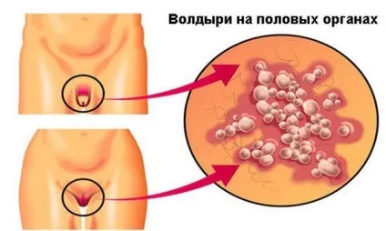 Білі пухирці на голівці у чоловіків, що це за прищики, як лікувати сальні залози