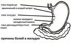 Болі в шлунку (біль у шлунку)