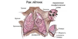 Болять легкі при кашлі що робити, як лікувати (болять) Болять легкі при кашлі що робити, як лікувати