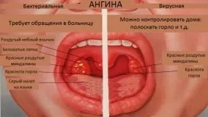 Хвороби гортані і горла - список захворювань і прогноз (горла) Хвороби гортані і горла - список захворювань і прогноз