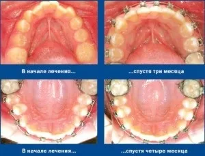 Брекети на нижню щелепу (щелепа) Брекети на нижню щелепу