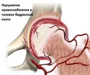 Хвороба Пертеса лікування, клініка, етіологія (клініка) Хвороба Пертеса лікування, клініка, етіологія