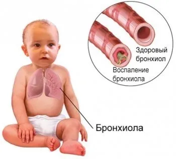 Бронхиолит - що це таке, симптоми і лікування (функції зовнішнього дихання) Бронхиолит - що це таке, симптоми і лікування