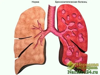 Бронхоектатична хвороба легенів симптоми, ускладнення, лікування (бронхоектатична) Бронхоектатична хвороба легенів симптоми, ускладнення, лікування
