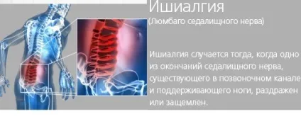 Біль в попереку при ходьбі, розгинанні і згинанні, нахилі, вставанні, лежачи на животі або спині, (розгинанні) Біль в попереку при ходьбі, розгинанні і згинанні, нахилі, вставанні, лежачи на животі або спині,